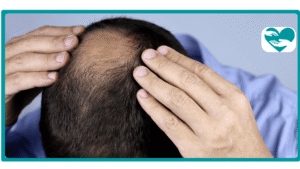 Does Enclomiphene Cause Hair Loss in Men